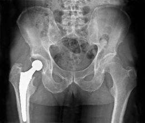 arthroplastie radiographie 300x254