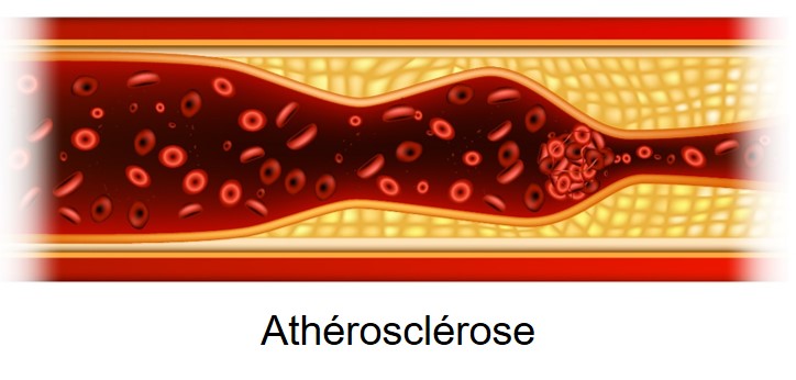 Atherosclerose