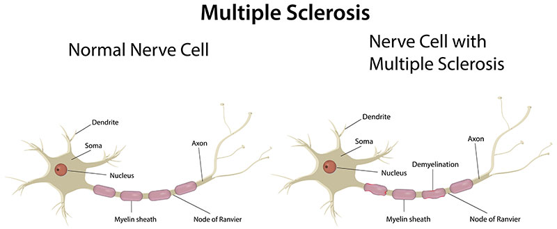 sclerose en plaques 01